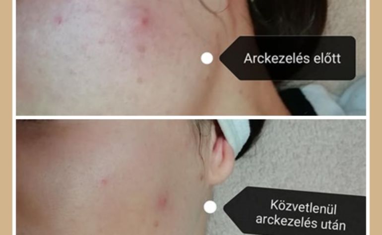 Milyen lesz a bőröm arckezelés után?